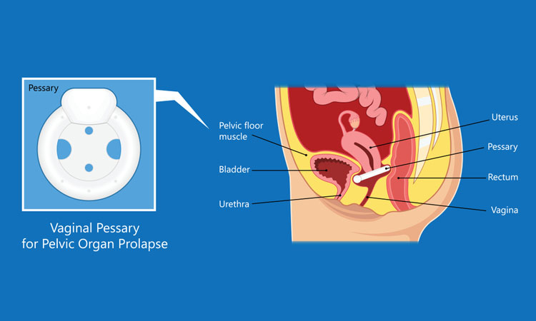 Uterus prolapse treatment